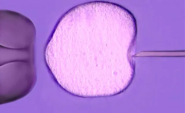 Fertilização in vitro - injeção do óvulo